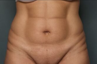 Großes Bauchdeckenstraffung: Vorher-Nachher-Ergebnisse und Erfahrungen im Überblick