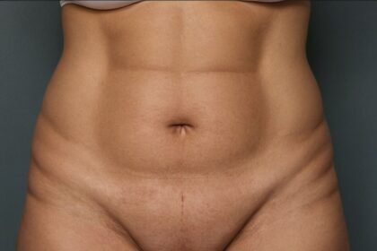 Großes Bauchdeckenstraffung: Vorher-Nachher-Ergebnisse und Erfahrungen im Überblick